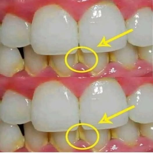 Naturalny sposób na błyskawiczne usunięcie płytki nazębnej – efekt w 5 minut bez dentysty