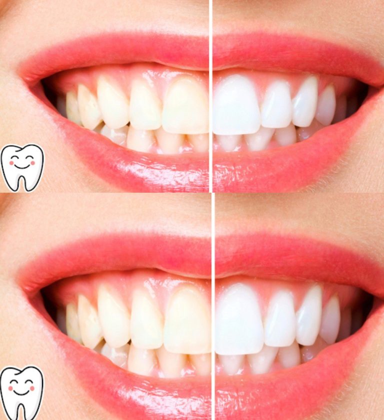 Odkryj Sekret Dentysty na Bielsze Zęby: Naturalna Metoda, Która Działa!