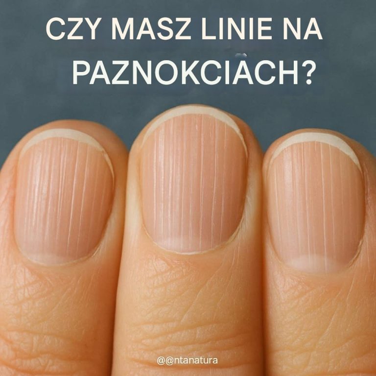 Smugi i linie na paznokciach: co oznaczają?